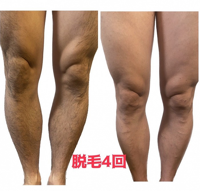 メンズ脱毛　全身脱毛　ヒゲ脱毛