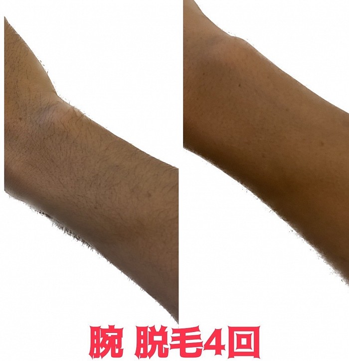 メンズ脱毛　全身脱毛　ヒゲ脱毛
