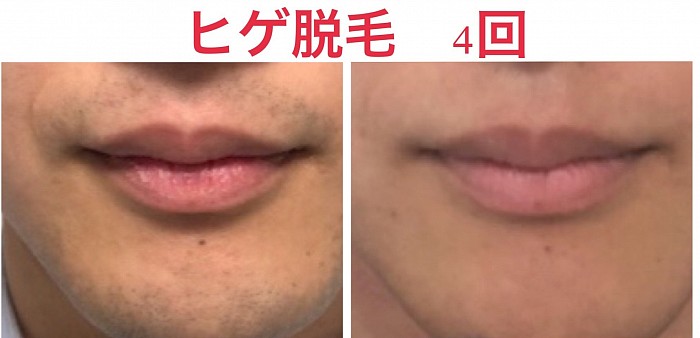 メンズ脱毛　全身脱毛　ヒゲ脱毛